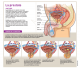 Infographie explicative sur le cancer de la prostate