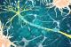 Sclérose en plaques : des défauts de remyélinisation dans certaines zones cérébrales associés à une plus grande neurodégénérescence